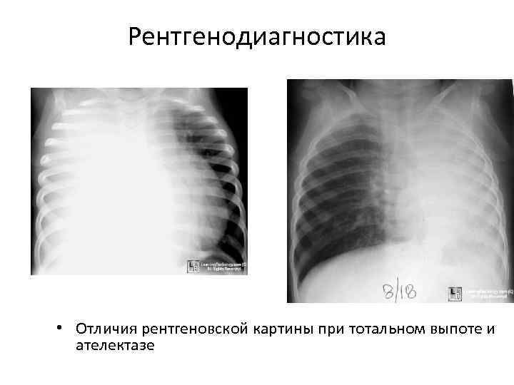   Рентгенодиагностика • Отличия рентгеновской картины при тотальном выпоте и  ателектазе 