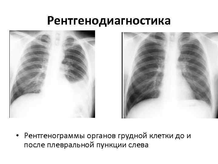   Рентгенодиагностика • Рентгенограммы органов грудной клетки до и  после плевральной пункции