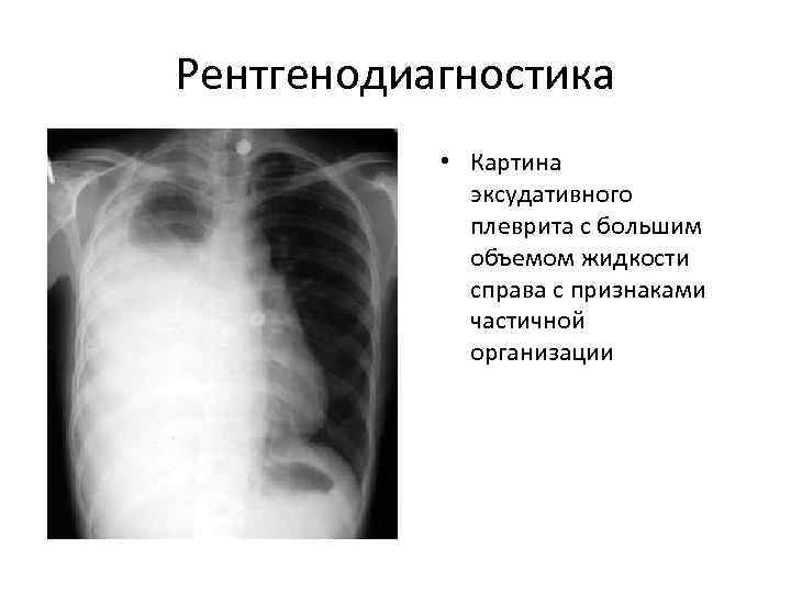 Рентгенодиагностика   • Картина   эксудативного   плеврита с большим 