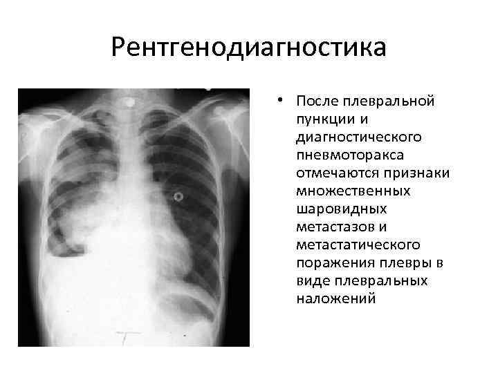 Рентгенодиагностика   • После плевральной   пункции и   диагностического 