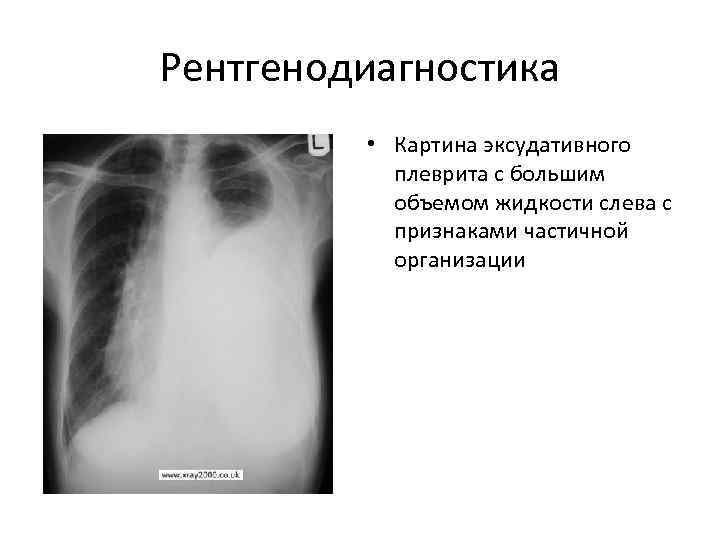 Рентгенодиагностика  • Картина эксудативного  плеврита с большим  объемом жидкости слева с