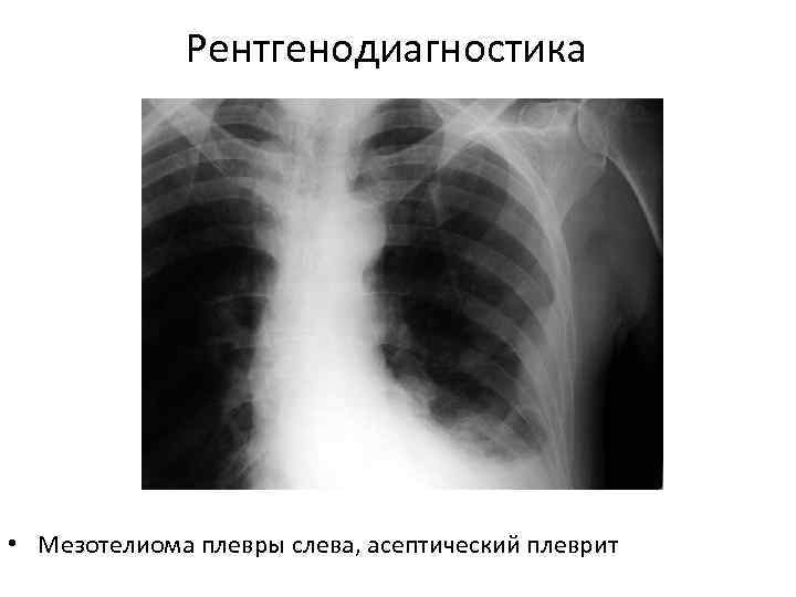    Рентгенодиагностика • Мезотелиома плевры слева, асептический плеврит 