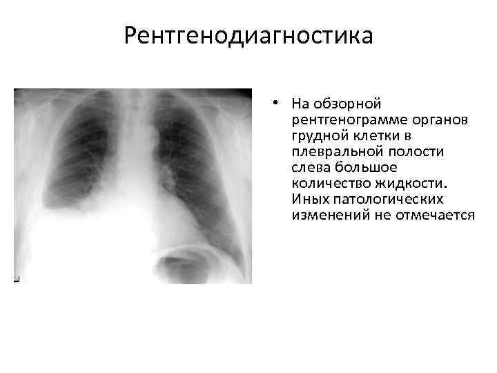 Рентгенодиагностика   • На обзорной   рентгенограмме органов   грудной клетки
