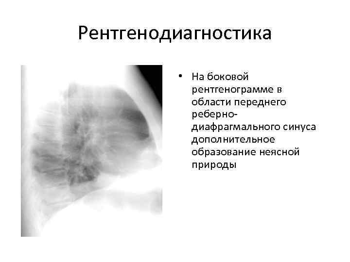 Рентгенодиагностика  • На боковой  рентгенограмме в  области переднего  реберно- 