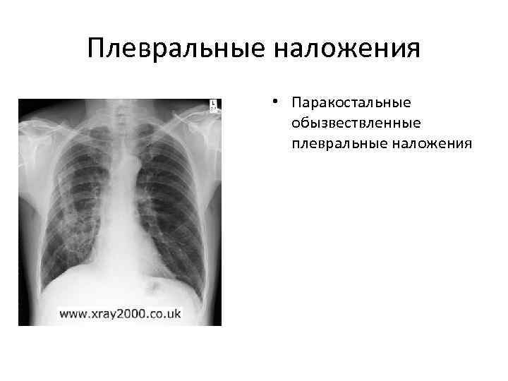 Плевральные наложения   • Паракостальные   обызвествленные   плевральные наложения 