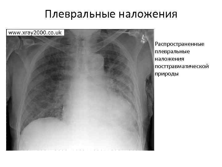 Плевральные наложения    • Распространенные    плевральные   