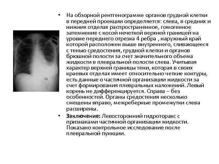  • На обзорной рентгенограмме органов грудной клетки  в передней проекции определяется: слева,