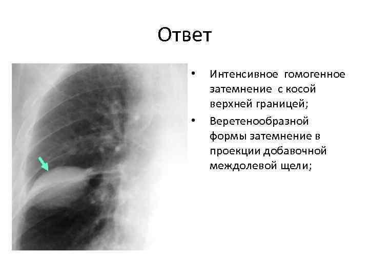 Ответ •  Интенсивное гомогенное  затемнение с косой  верхней границей; • 