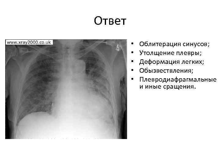 Ответ   •  Облитерация синусов;  •  Утолщение плевры;  •