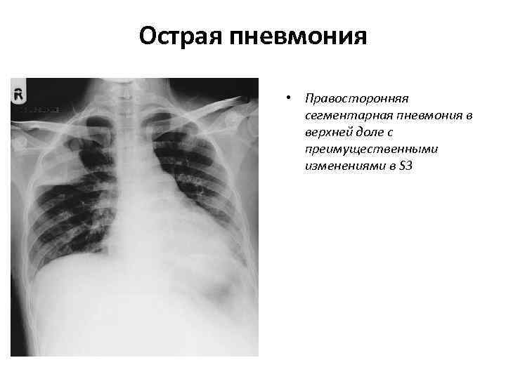 >Острая пневмония   • Правосторонняя   сегментарная пневмония в   верхней