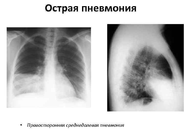    Острая пневмония • Правосторонняя среднедолевая пневмония 