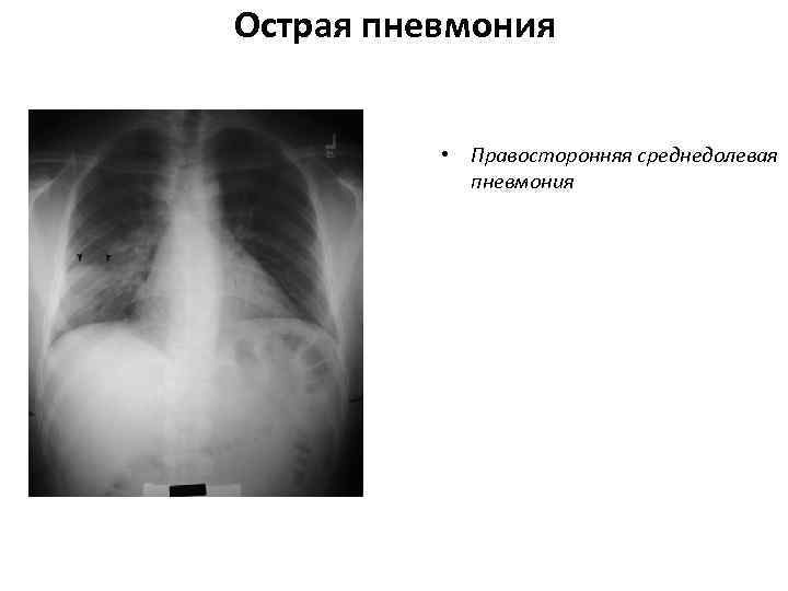 >Острая пневмония   • Правосторонняя среднедолевая   пневмония 