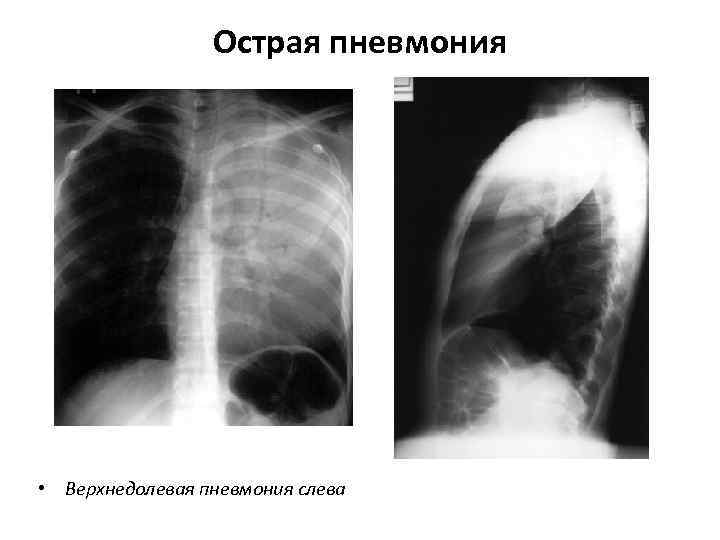 Плевропневмония. Острая пневмония левого легкого. Левосторонняя верхнедолевая пневмония. Плевропневмония рентген. Верхнедолевая пневмония слева.