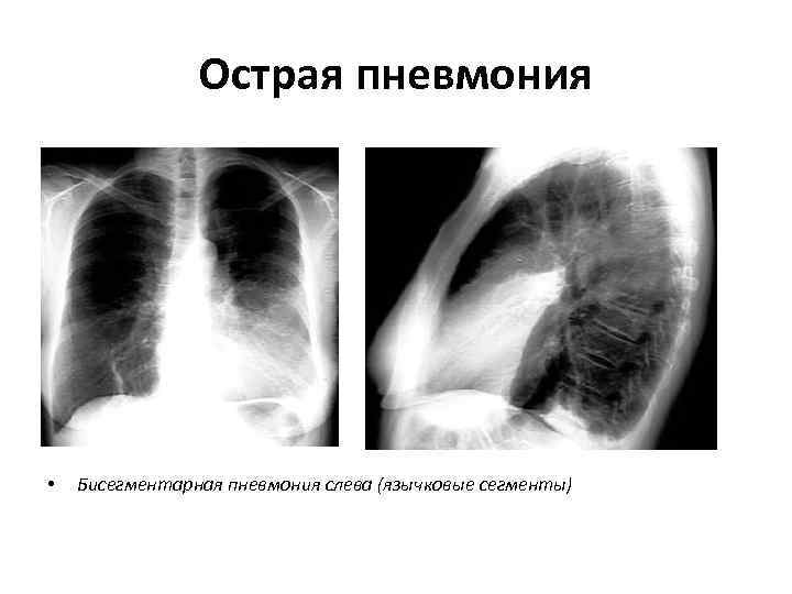     Острая пневмония •  Бисегментарная пневмония слева (язычковые сегменты) 