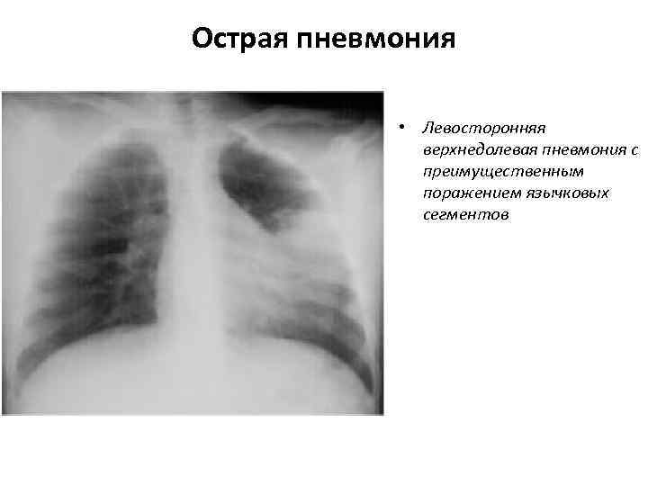 Острая пневмония    • Левосторонняя    верхнедолевая пневмония с 