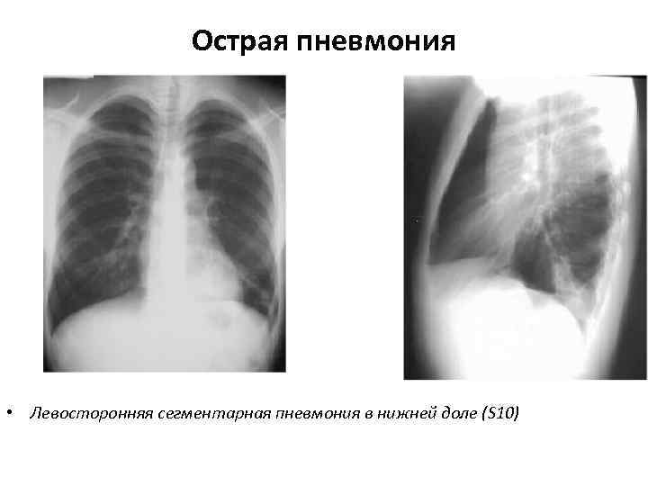 >    Острая пневмония • Левосторонняя сегментарная пневмония в нижней доле (S