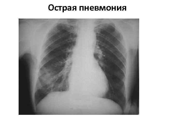 >Острая пневмония 