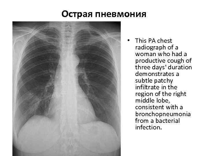 >Острая пневмония    • This PA chest    radiograph of