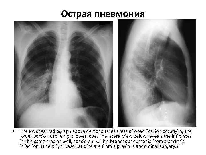     Острая пневмония •  The PA chest radiograph above demonstrates