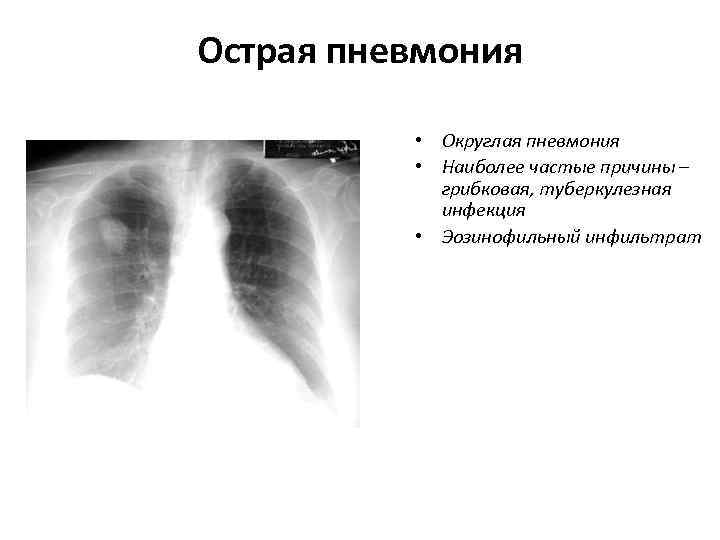 Острая пневмония   • Округлая пневмония  • Наиболее частые причины – 