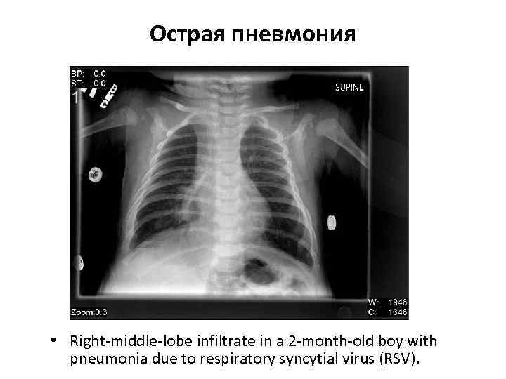 >   Острая пневмония • Right-middle-lobe infiltrate in a 2 -month-old boy with
