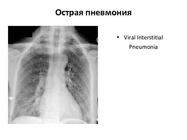 >Острая пневмония    • Viral Interstitial   Pneumonia 