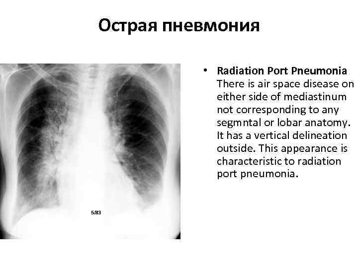 Острая пневмония   • Radiation Port Pneumonia   There is air space