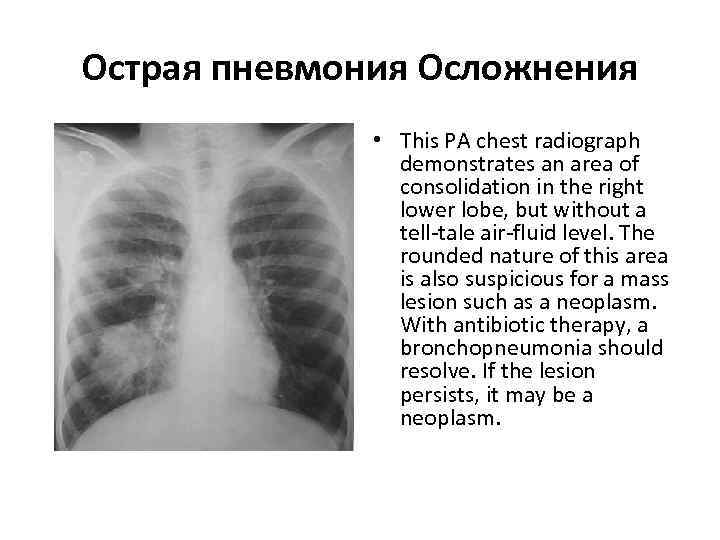 >Острая пневмония Осложнения    • This PA chest radiograph   demonstrates