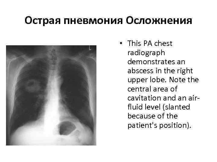 Острая пневмония Осложнения   • This PA chest    radiograph 