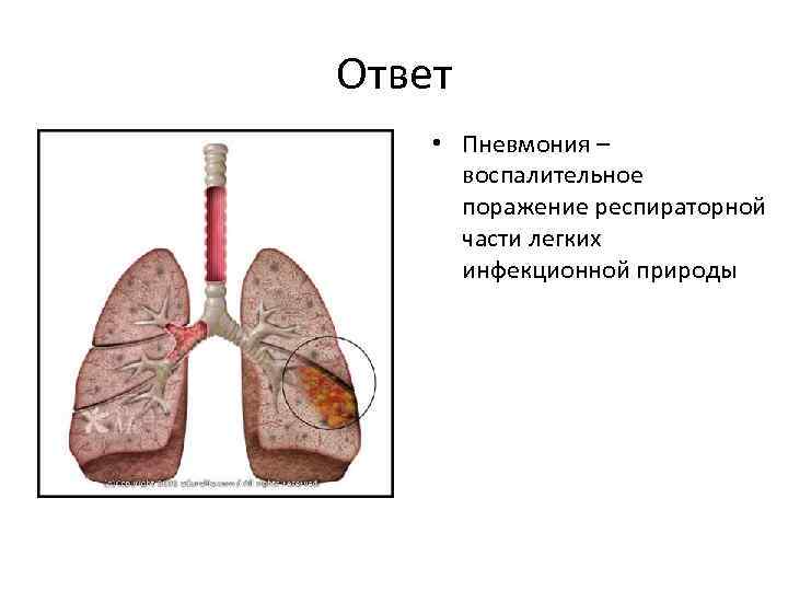 Части легкого. Респираторная часть легкого. Болит верхняя часть легких. Пневмония с поражением 1 сегмента. Поражение одного сегмента легкого.