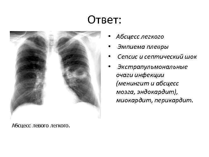 История болезни абсцесс легкого. Рентгенодиагностика абсцесса легкого. Абсцесс нижней доли левого легкого. Эмпиема и абсцесс легкого. Абсцесс легкого от эмпиемы.