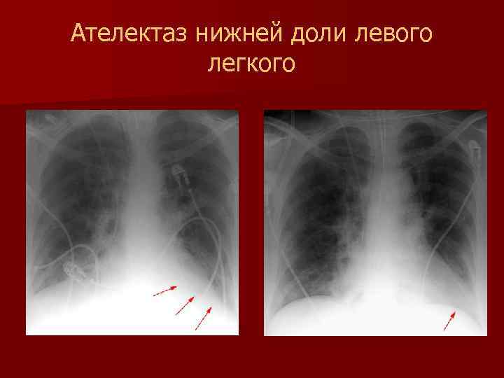 Ателектаз нижней доли легкого