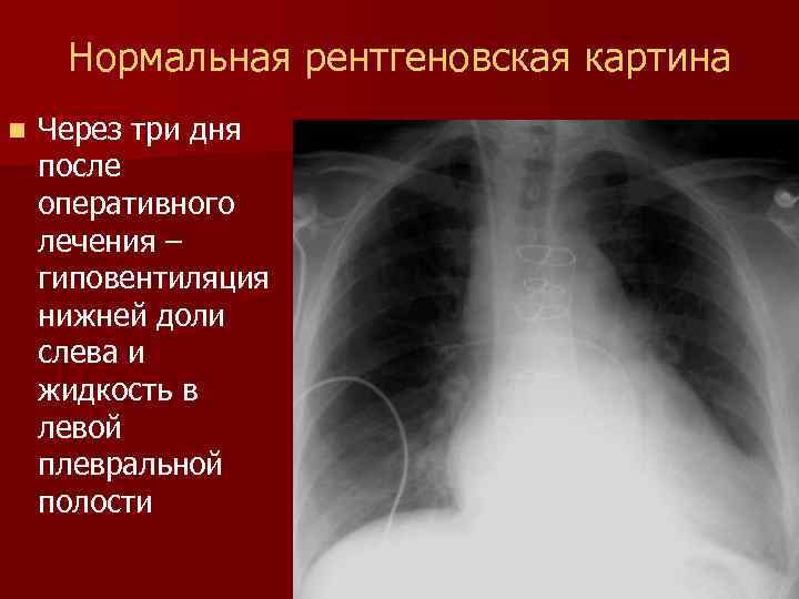 Хламидийная пневмония рентгенологическая картина - 85 фото