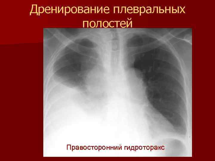 Гидроторакс отек. Правосторонний гидроторакс. Тотальный правосторонний гидроторакс. Правосторонний гидроторакс рентген. Рентгенодиагностика гидроторакса.