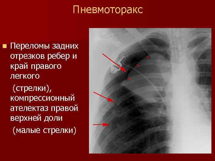 Рентген картина пневмоторакса