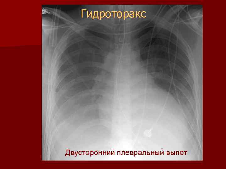 Признаки гидроторакса. Гидроторакс рентген признаки. Плевральный выпот рентген. Рентгенодиагностика гидроторакса. Субтотальный гидроторакс.