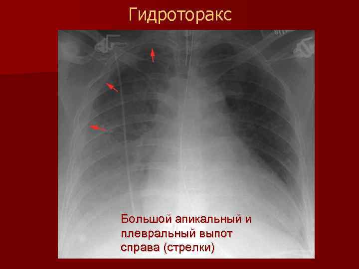 Гидроторакс карта вызова