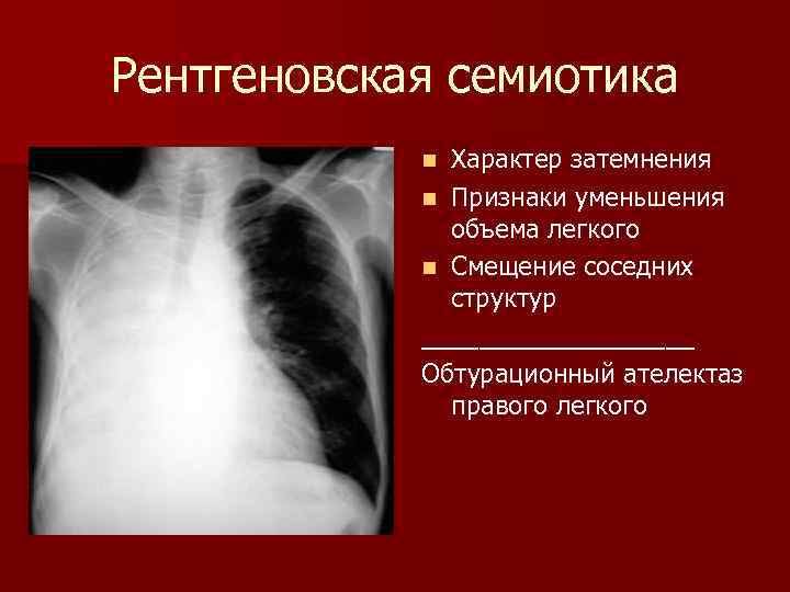 Сокращение легких. Обтурационный ателектаз легкого. Обтурационный ателектаз лучевая диагностика. Ателектаз рентген признаки. Лучевые симптомы обтурационного ателектаза.