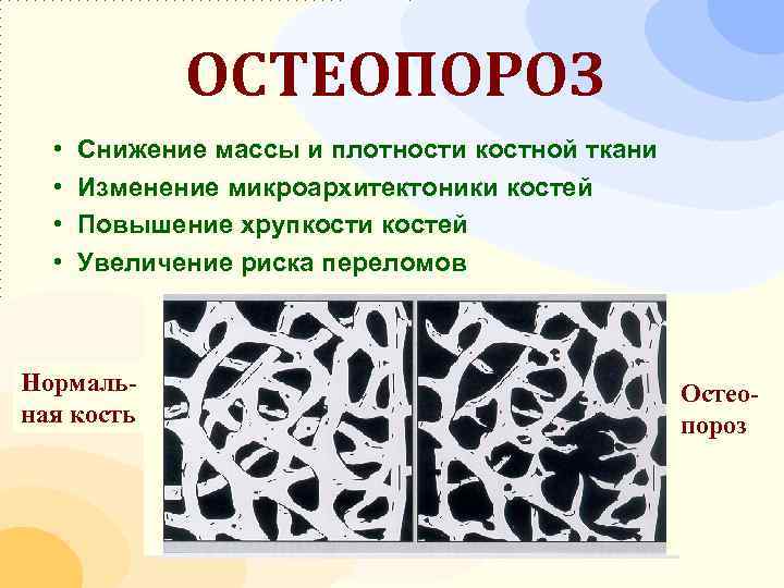 Плотный часто. Уменьшение плотности костей. Снижение плотности кости. Плотность костной ткани. Снижение плотности костной ткани.