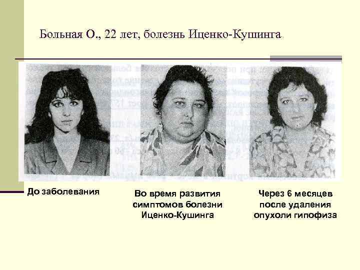  Больная О. , 22 лет, болезнь Иценко-Кушинга До заболевания  Во время развития