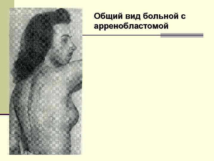Общий вид больной с арренобластомой 