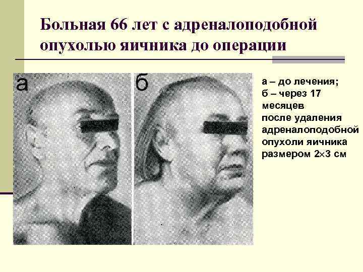 Больная 66 лет с адреналоподобной опухолью яичника до операции     