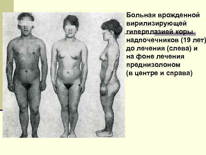 Больная врожденной вирилизирующей гиперплазией коры надпочечников (19 лет) до лечения (слева) и на фоне