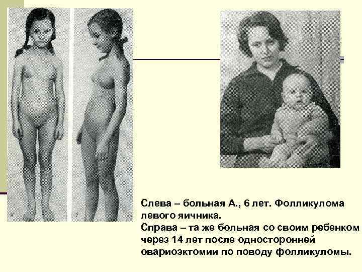 Слева – больная А. , 6 лет. Фолликулома левого яичника. Справа – та же