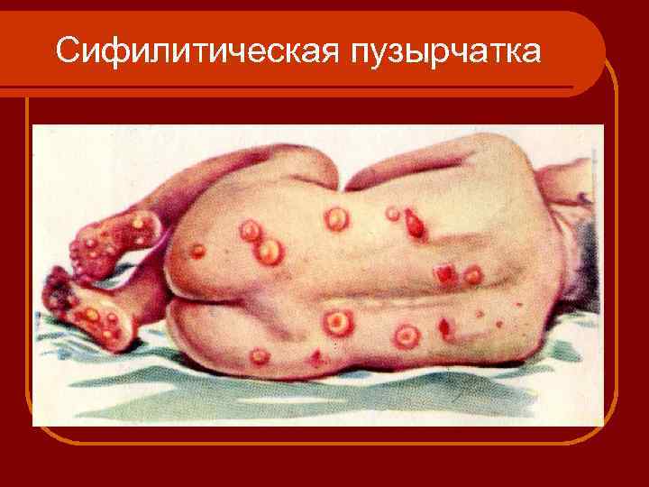 Сифилитическая пузырчатка 