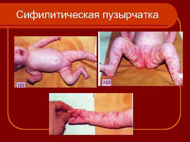 Сифилитическая пузырчатка 