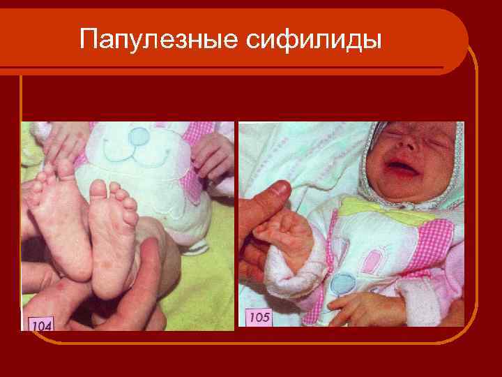 Папулезные сифилиды 