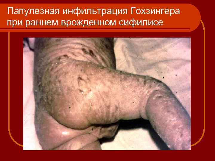 Папулезная инфильтрация Гохзингера при раннем врожденном сифилисе 