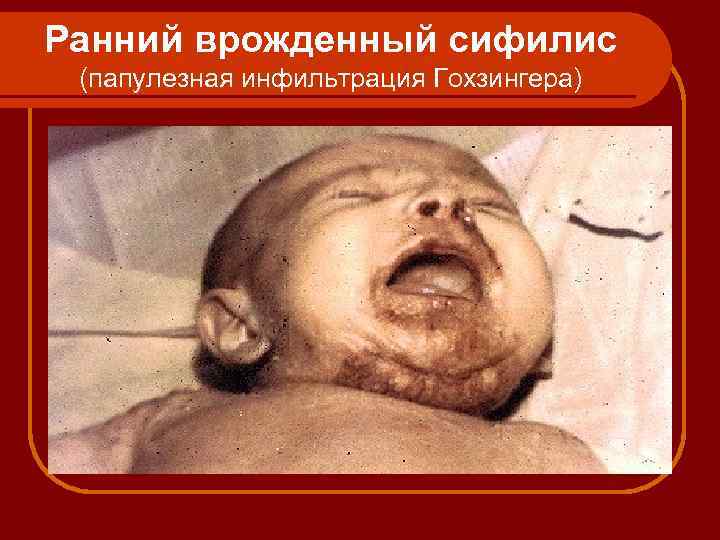 Ранний врожденный сифилис (папулезная инфильтрация Гохзингера) 