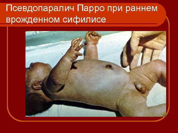 Псевдопаралич Парро при раннем врожденном сифилисе 
